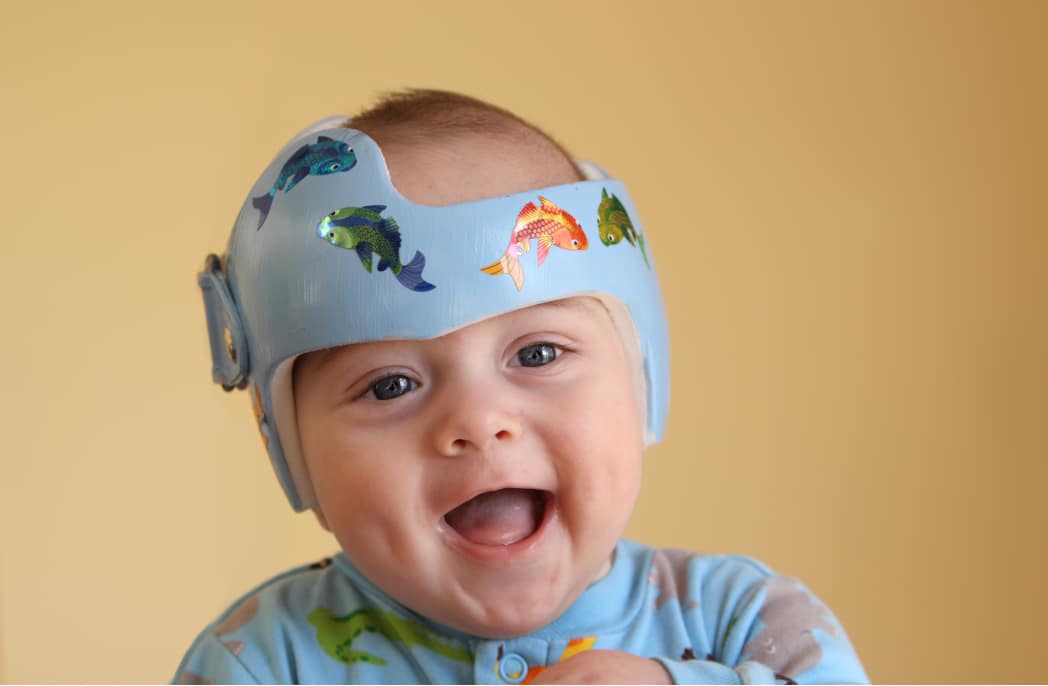 A smiling child using helmet therapy.