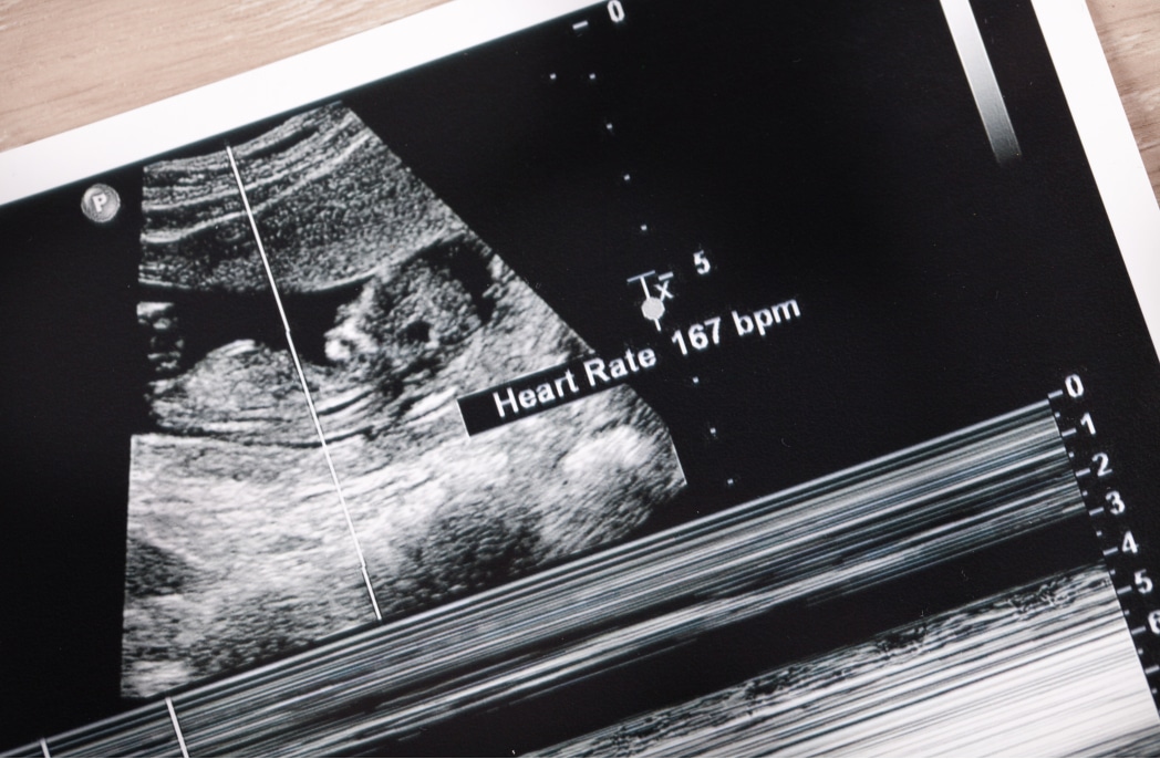 An ultrasound showing a child's heart rate.