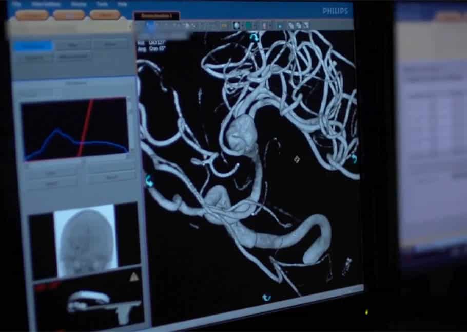 A scan of a patient's brain for a stroke is shown.