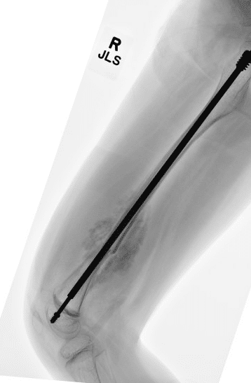 Telescoping Rod 2